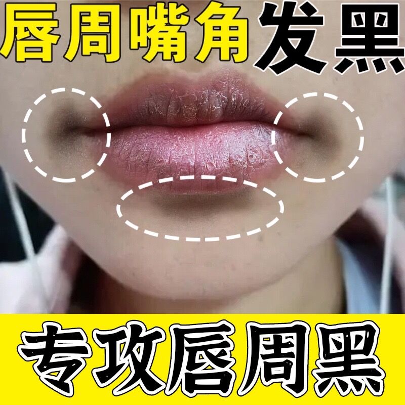 改善唇周黑去唇周暗沉唇角边黑祛嘴角嘴巴嘴唇周边发黑去除黑色素