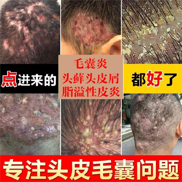 治疗牛皮藓毛囊炎牛皮癣药膏真菌感染藓药膏皮肤外用真菌感染头藓在类目 本地化生活服务, 健康服务, 预约就医, 健康咨询中 - 来自Buy2taobao.com提供专业的淘宝代购服务