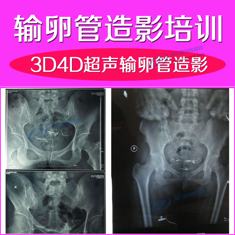 B超视频教程3D4D三维盆底超声子宫输卵管超声造影培训视频送妇科