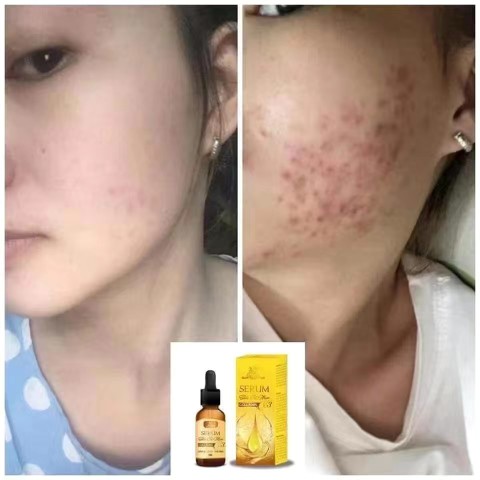 SERUM TRANG DA  ngua mun mo tham越南精华液祛痘水黑头粉刺痘印