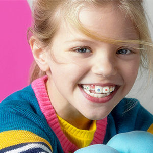 隐形牙套美国进口图片