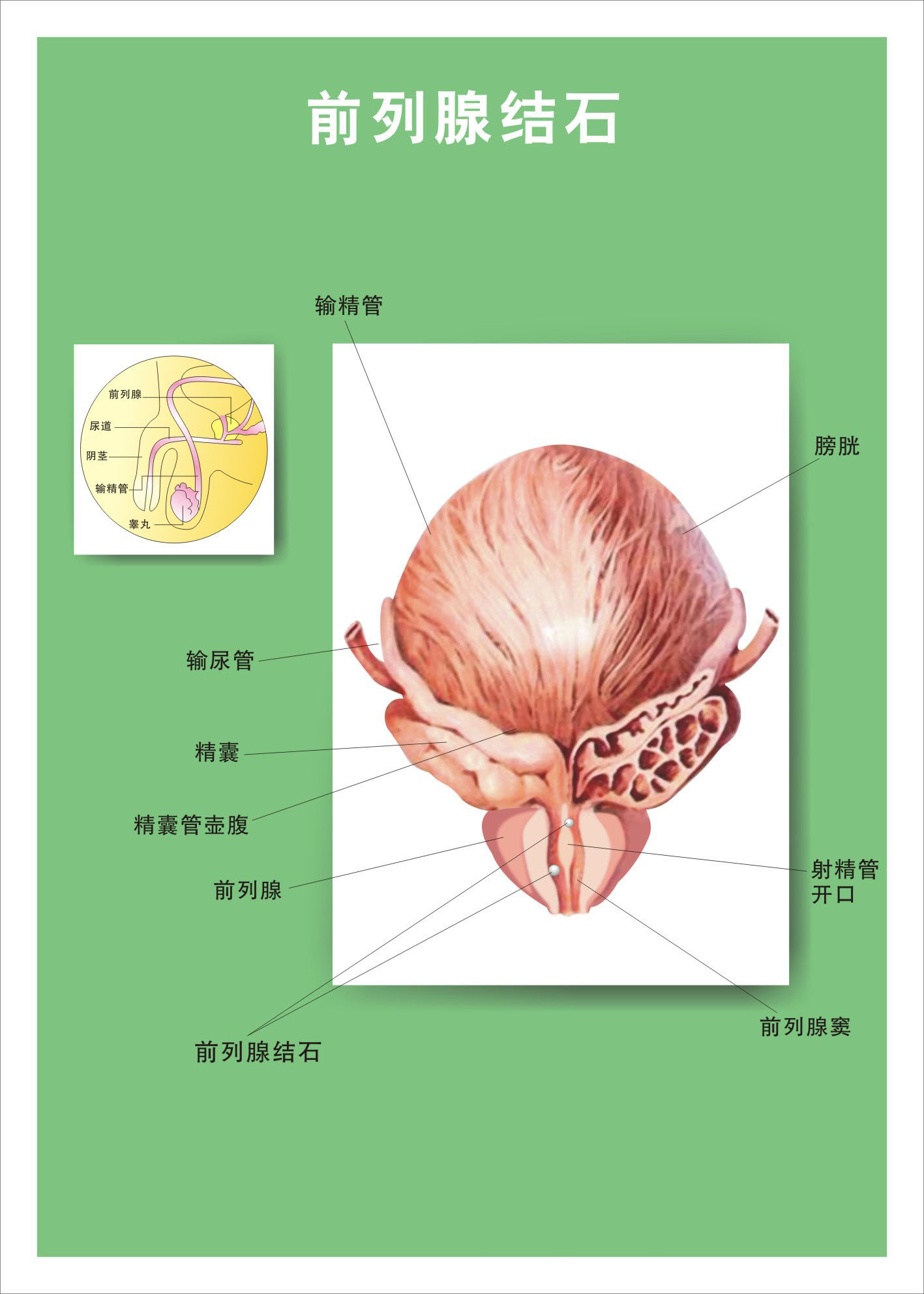 海报结石印制展板写真喷绘贴纸医院前列腺写真