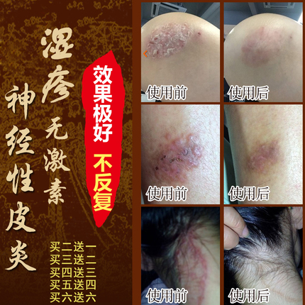 阴囊神经性皮炎主题推荐 (精选1件)