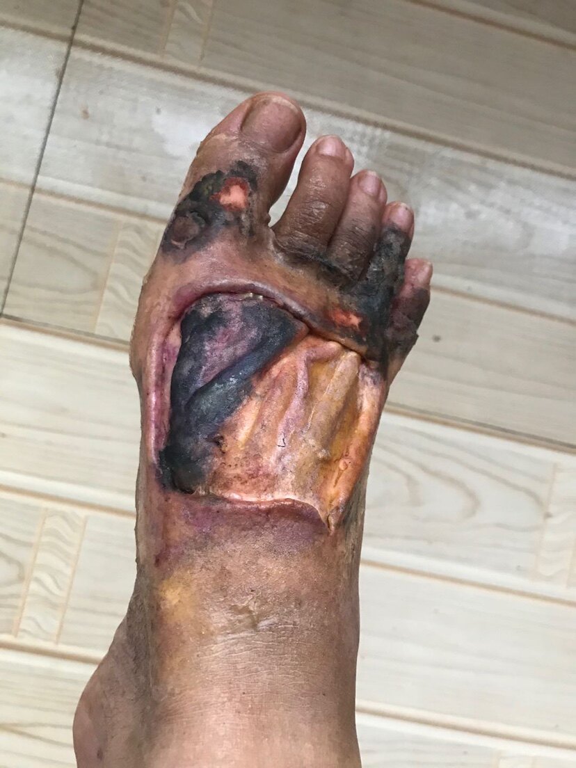 伤疤烧伤特效化妆伤情化妆