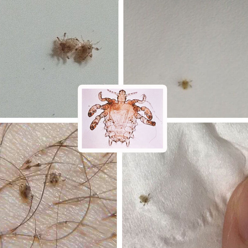 虱子百部净虱扫光虱卵男女喷剂阴虱