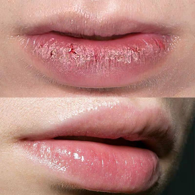 口唇唇膏药用软膏嘴唇干裂脱皮起皮上火起泡润唇膏