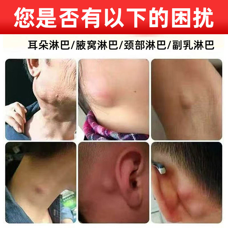 淋巴下腹消除疏通收副结节腋下散结颈耳膏贴保健护具护腰