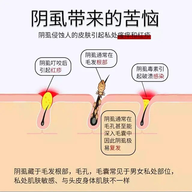 长阴虱的症状图片