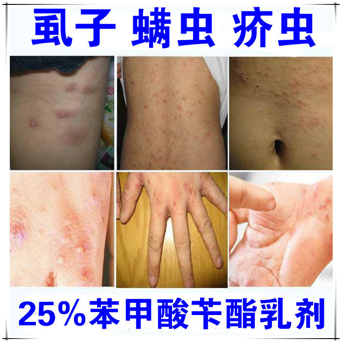 2瓶苯甲酸苄酯乳剂擦搽剂疥螨毛囊螨皮脂蠕形头螨消毒液