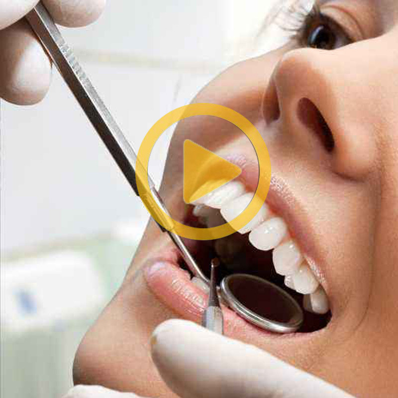 牙齿清洁工具牙结石去除器洗牙牙石清除剔牙神器牙垢刮牙渍便携式