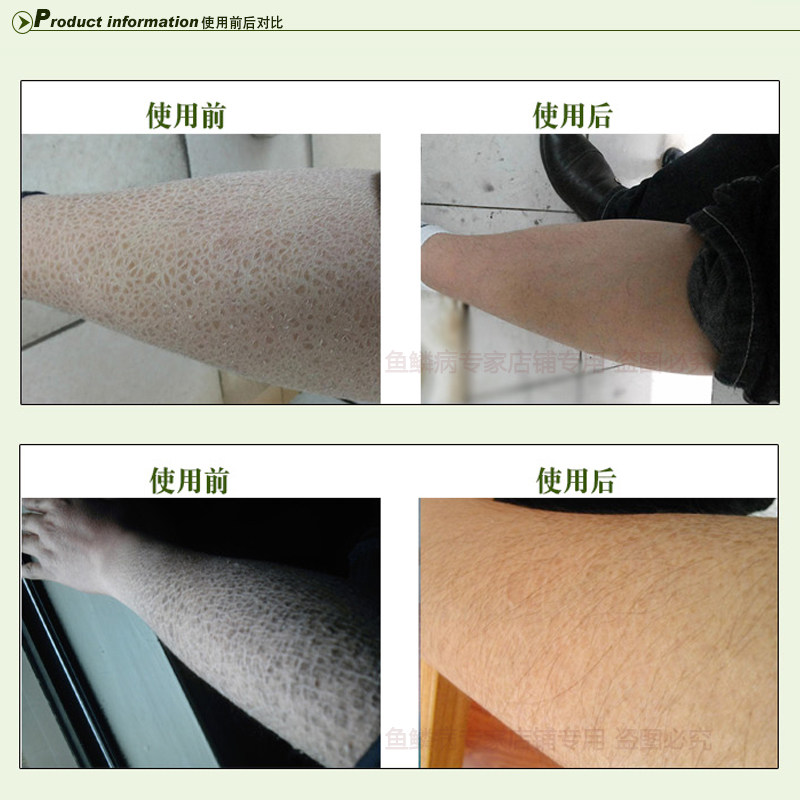 物华本草去除鱼鳞特效蛇皮肤霜腿保湿滋润补水病干性肤质全身体乳