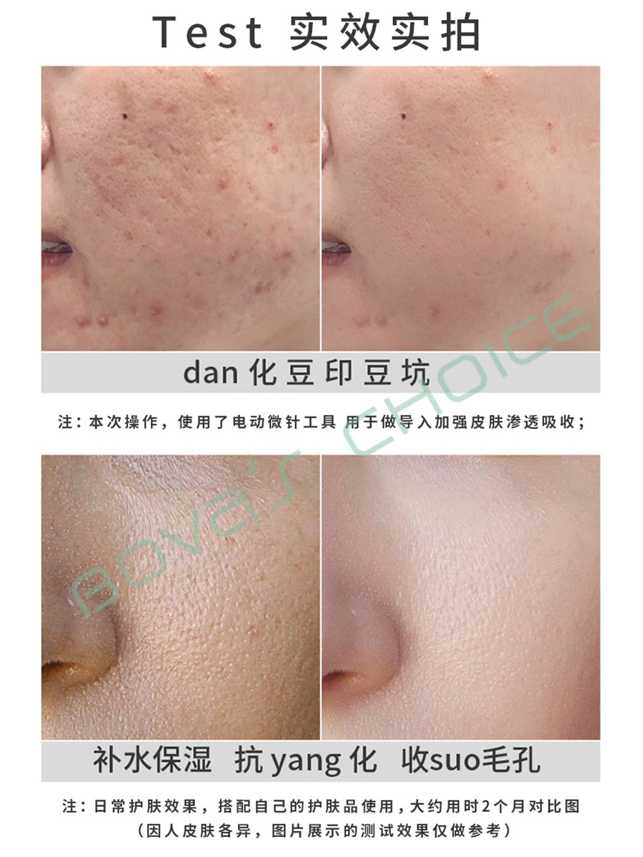 暨大浅导修护冻干粉mts微针导入祛痘淡化痘印痘坑寡肽因子8万单位