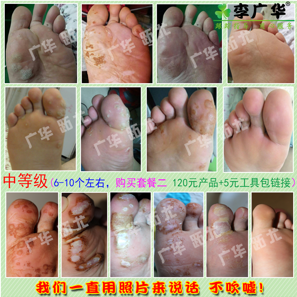 李广华好 猴子去除足脚底长肉刺黑点死茧趾尤镶嵌血泡刺广华跖尤