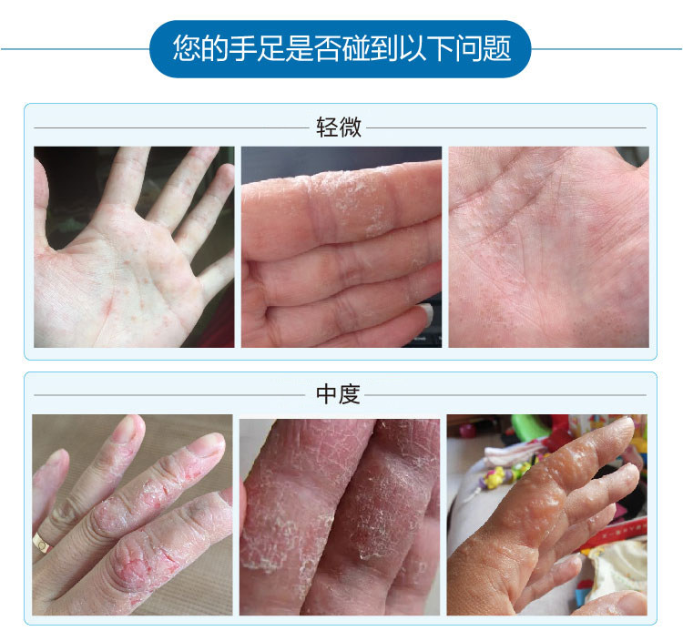 手脚长小泡汗疱泡疹痒脱皮汗疹手出汗去除正品汗疱宁汗康灵汗泡宁