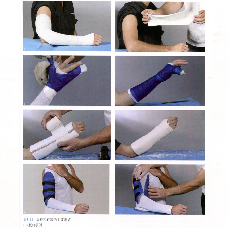 正版 石膏管型,夹板和支持绷带 骨折的非手术治疗与围术期保护 详细