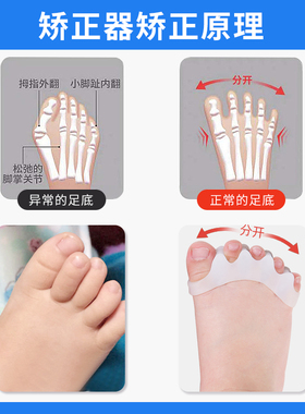 婴幼儿童脚趾重叠矫正器宝宝拇指外翻纠正弯曲内扣纠正矫形器小孩杰臣