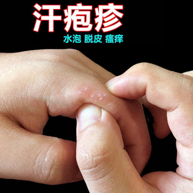 疱疹治疗汗孢疹汗鹅掌风干干裂脱皮手足脚泡动物保健品