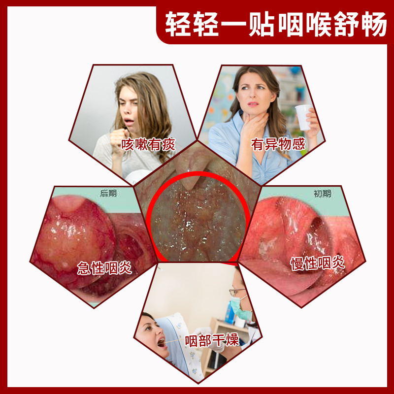咽炎咽喉炎慢性神器异物感穴位嗓子扁桃体发炎肥大膏药贴器械