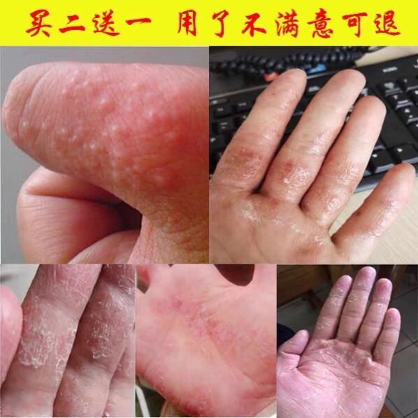 手脚脱水水泡季节性手掌手指头蜕皮严重干裂褪起护手霜