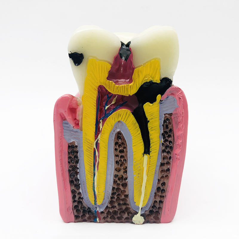 牙科口腔龋齿展示模型 6倍龋齿 蛀牙演变 牙科蛀牙解