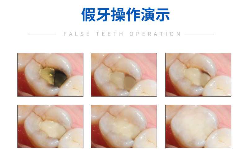 补牙自己补缝洞堵牙洞材料填充儿童牙齿有洞6863口腔科材料