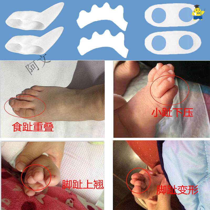 儿童大脚趾矫正脚指甲脚指五趾分趾器腿型拇指内翻保健护具护腰