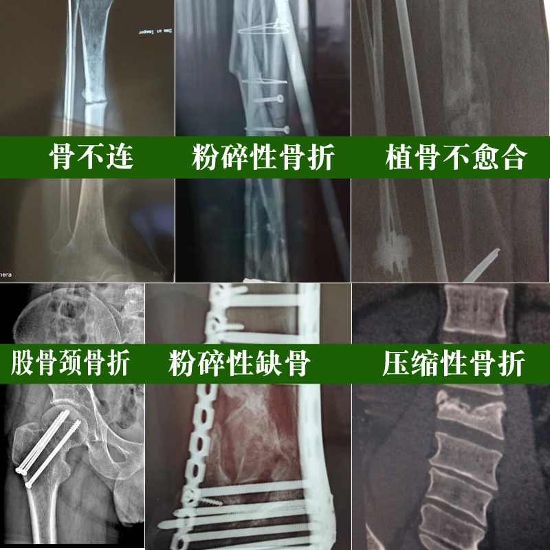 高档骨折骨裂愈合续筋接骨散生碎性带折韧骨护膝