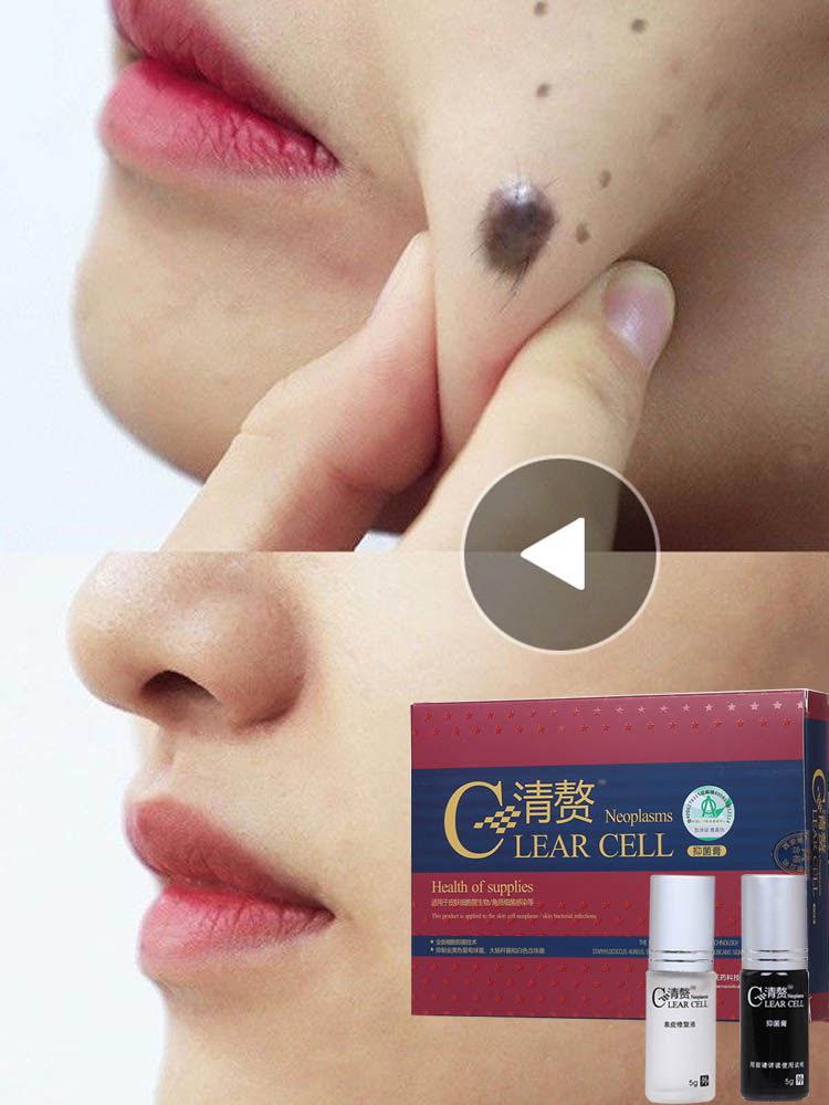 点痣水去痣膏痦子祛痣脸部药水无痕肉贴点斑膏痣肉刺肉痣清赘正品