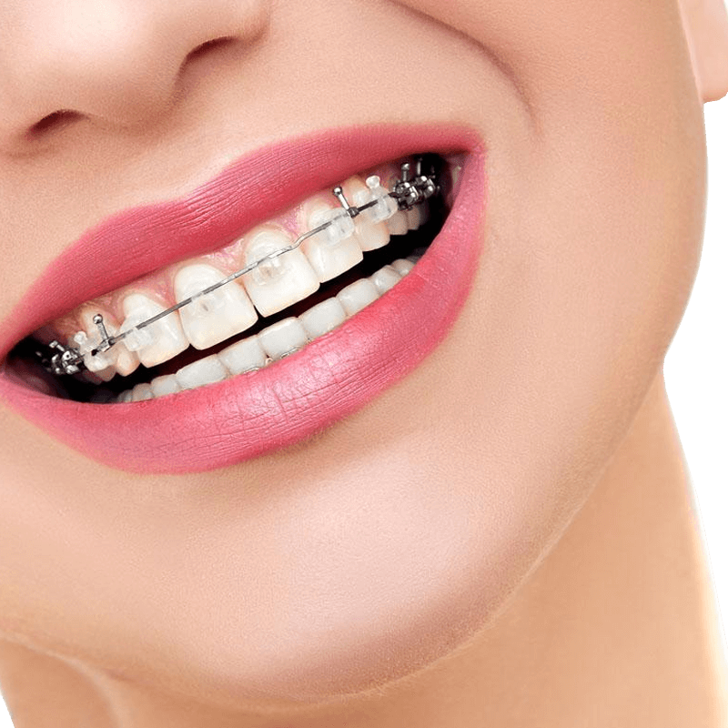 杭州齐尔口腔 金属自锁托槽矫正 专业经典正畸 金属矫正