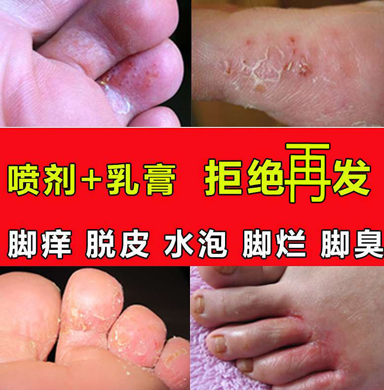 苗方肤毒康乳膏脚气喷剂除痒脱皮糜抑菌肤毒癣痒净烂水泡型脚气膏