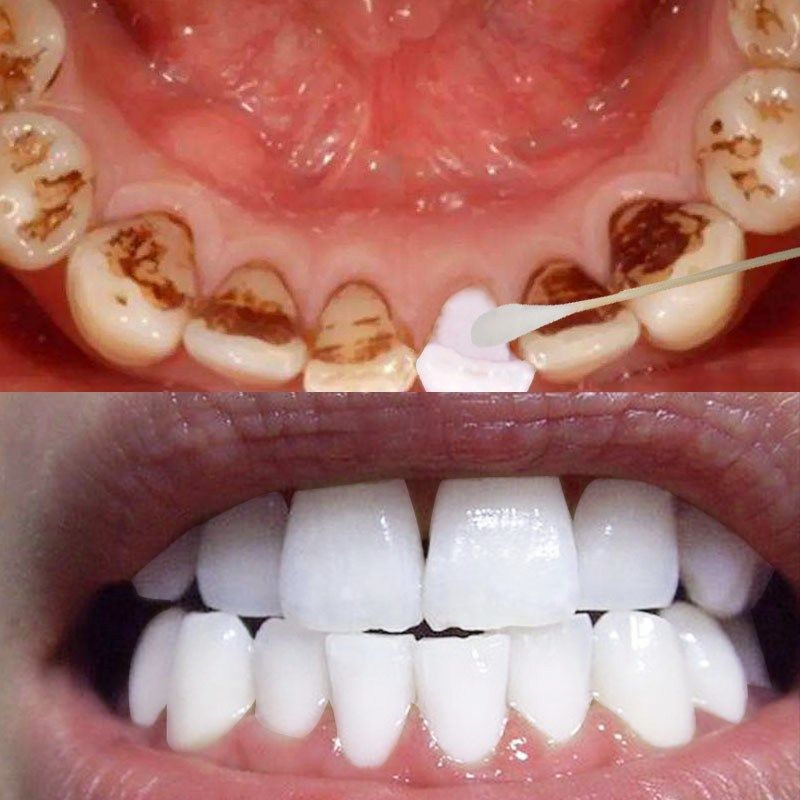 白牙斑净速效洁美脱色剂白白漂器牙齿白白牙粉神017白牙素2