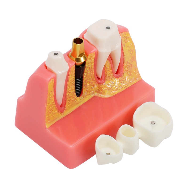 模型种植医患沟通4倍解说口腔教学学习分解教学仪器