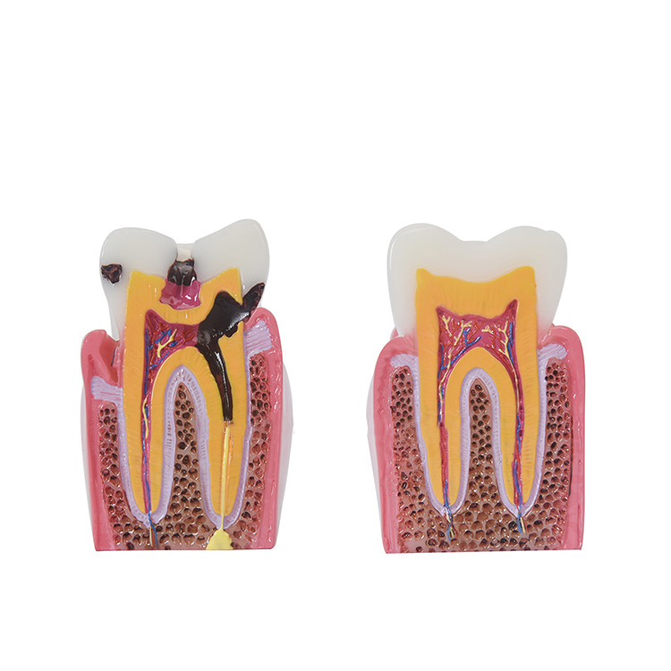 模型牙齿6倍龋齿对比蛀牙演示剖面医患沟通教学仪器