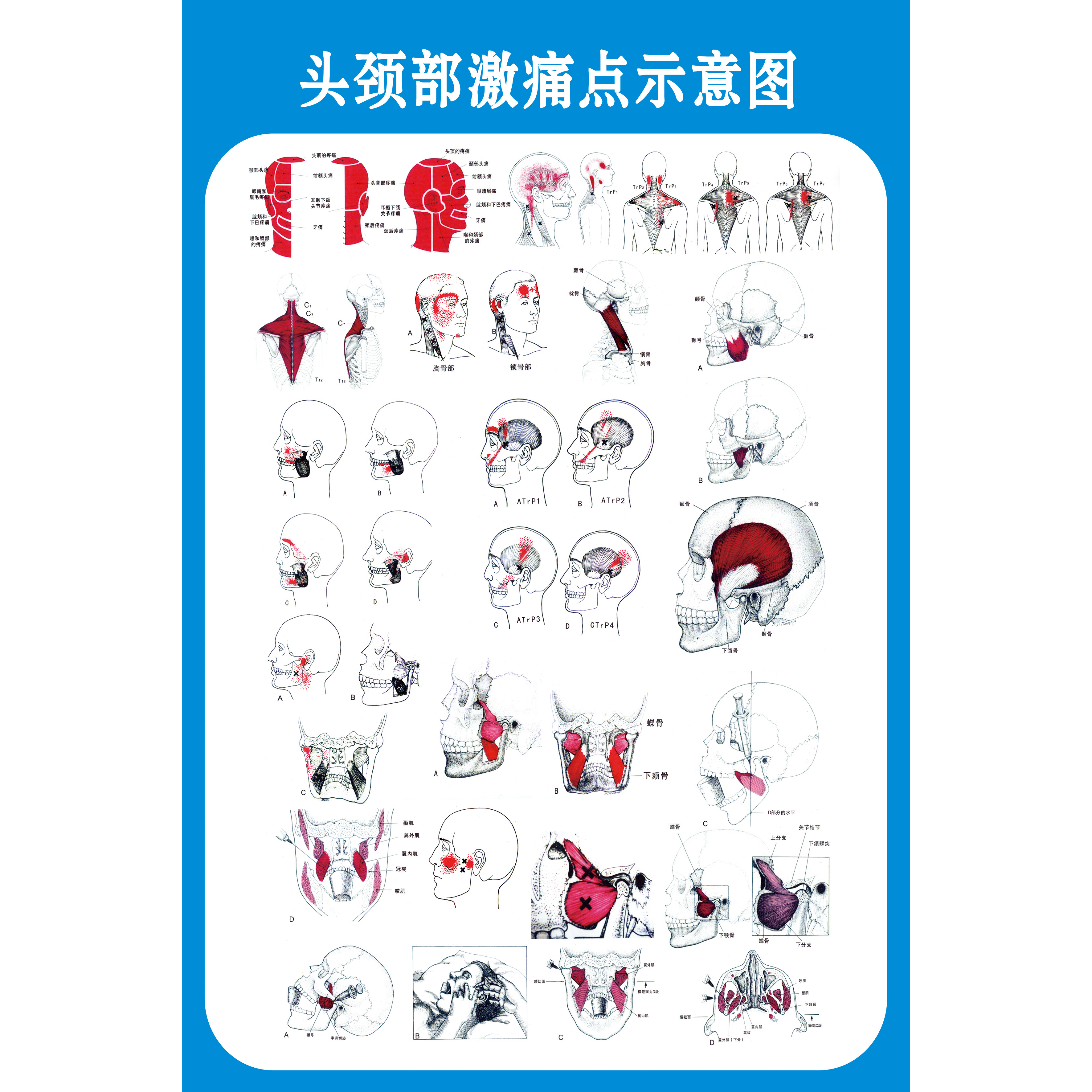 激痛点肌筋膜疼痛触发点示意图解人体肌肉解剖图解
