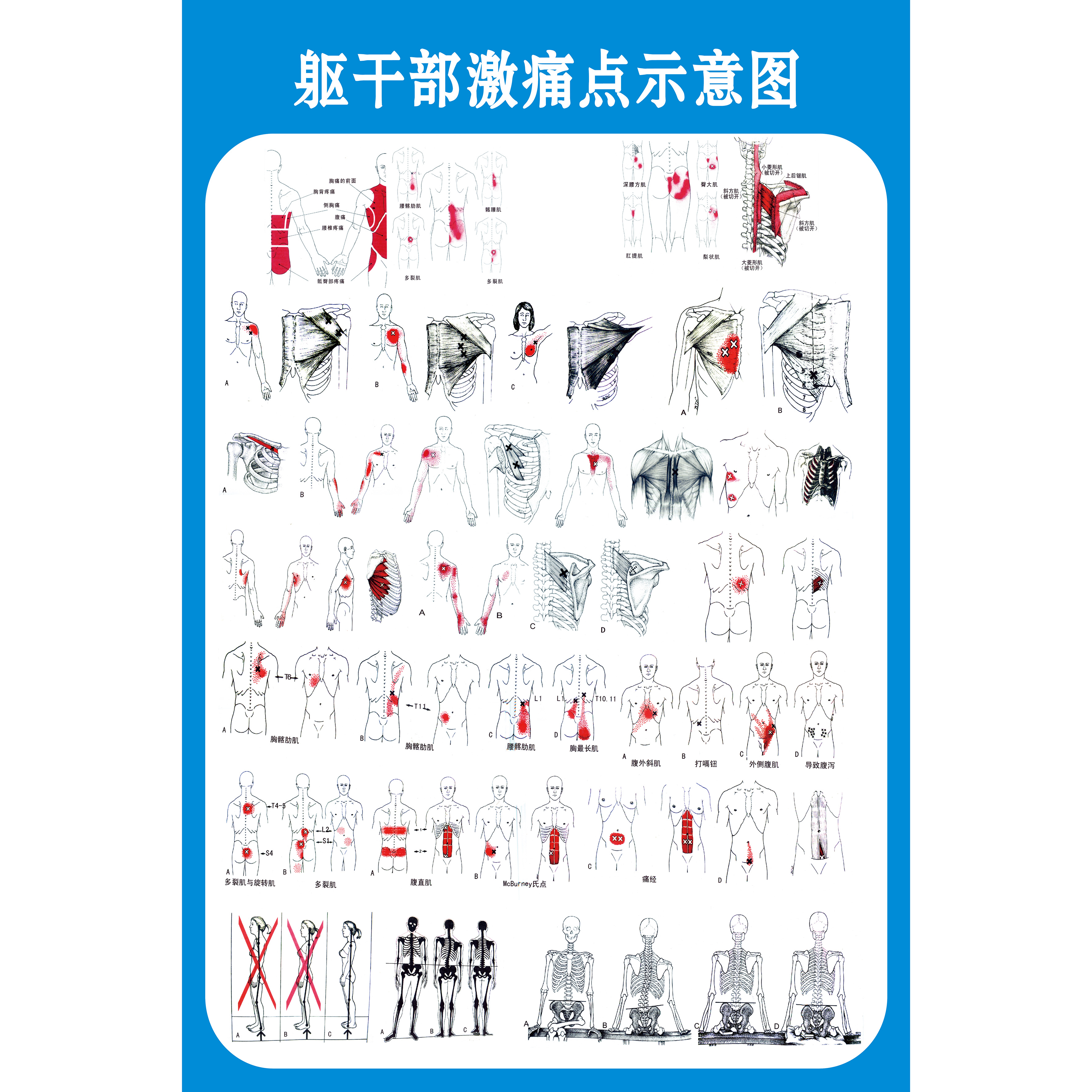 激痛点肌筋膜疼痛触发点示意图解人体肌肉解剖图解墙贴装饰画