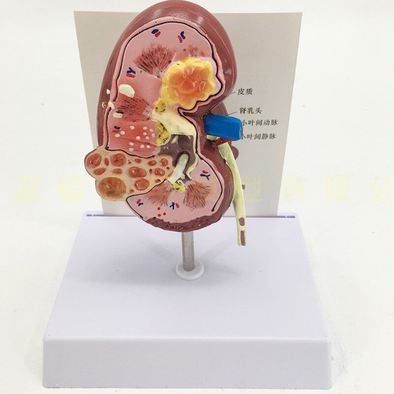 人体肾解剖模型,病变肾脏模型 肾脏模型 人体内脏器官解剖模型