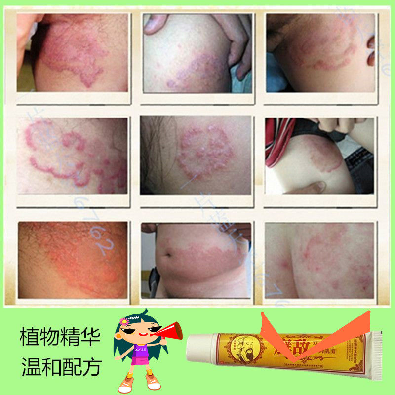 癣敌乳膏抑菌软膏外用皮肤去痒脱皮水泡正品其它