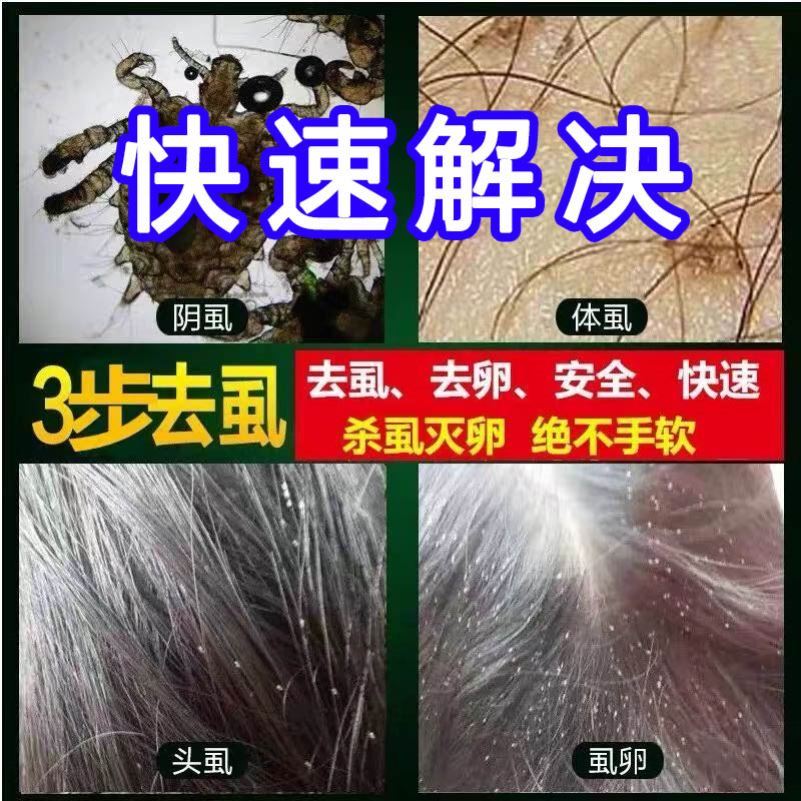 虱子儿童大人人用去除阴虱跳蚤小女孩头发长的杀虫剂卫生农药