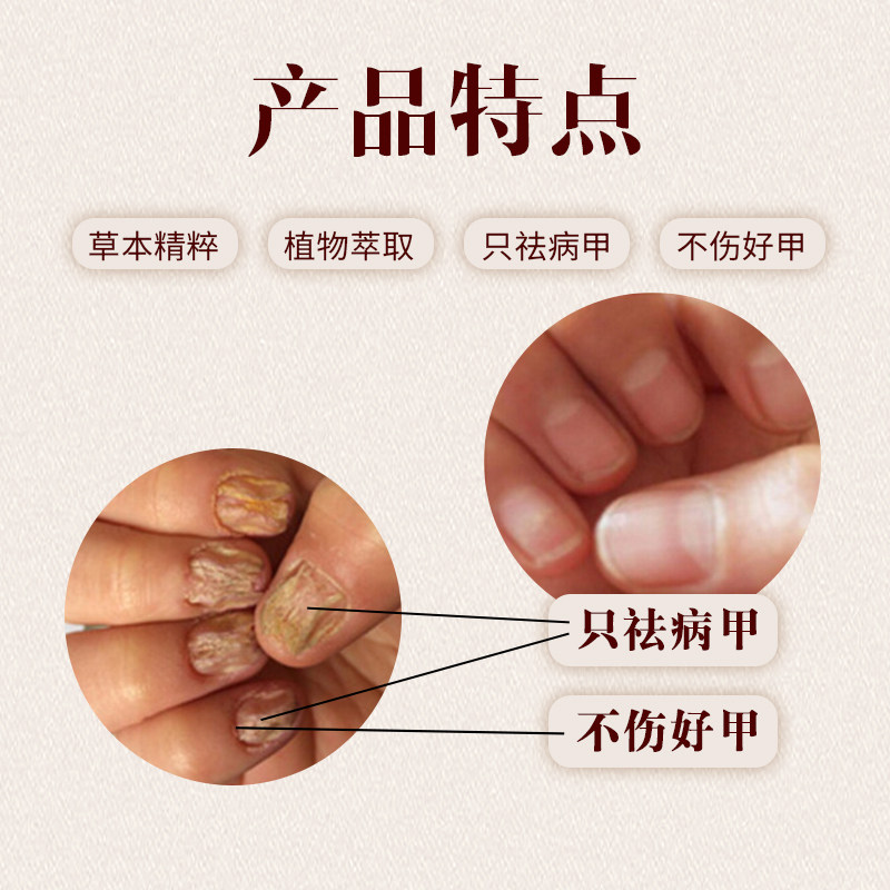 灰甲清 新亮灰甲王去除灰甲油液专用正品教授软甲膏进口方灰甲净