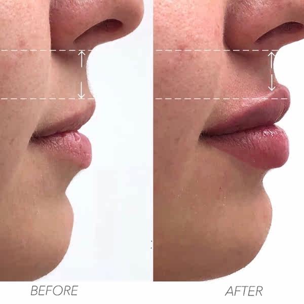 草本人中缩小缩短精华液 加深人中加宽加长 唇珠立体长五体官立