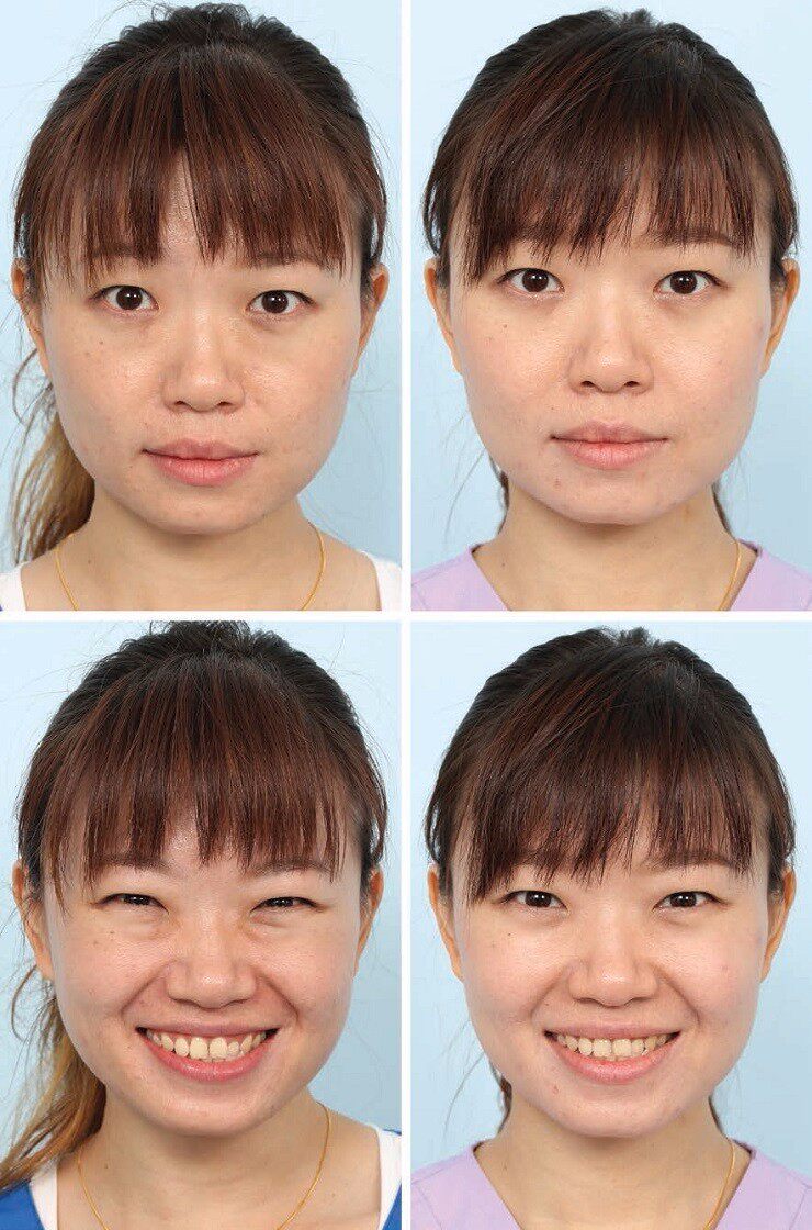泪沟修复精华霜 丰眼窝凹陷泪沟耳垂修复去平填充人鱼眼眸桃花