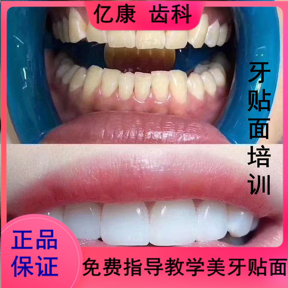 牙齿美白临时牙贴面贴片树脂牙片美牙商用牙贴片临时门牙 - 亿康齿科