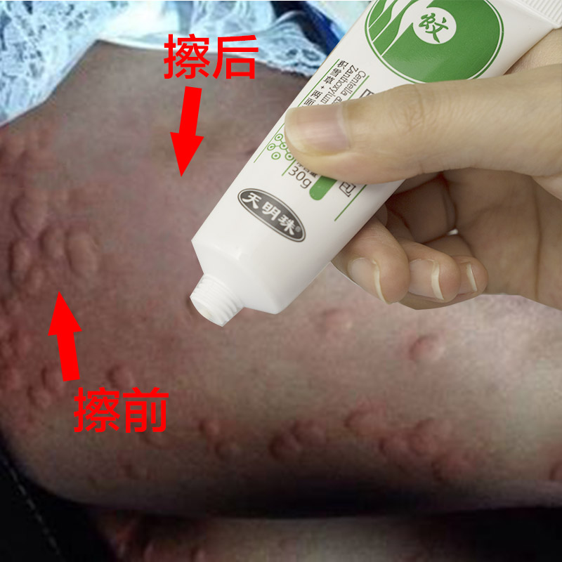 现货大眼睛叮痱灵25g婴儿童宝宝祛痱止痒消退叮痕膏无刺激舒缓霜