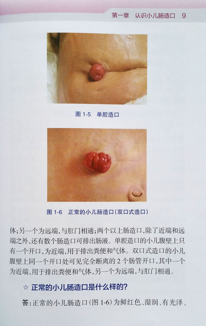 肠造口护理与康复指南丛书 小儿肠造口护理与康复指南 郑美春主编