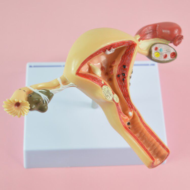 子宫病理病变模型 生殖科模型 医药礼品模型 女性子宫阴道模型