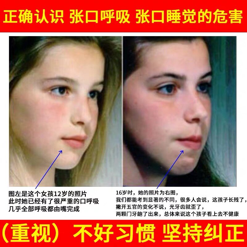 呼吸矫正器防张嘴睡觉闭嘴神器张口闭口口鼻矫姿用品