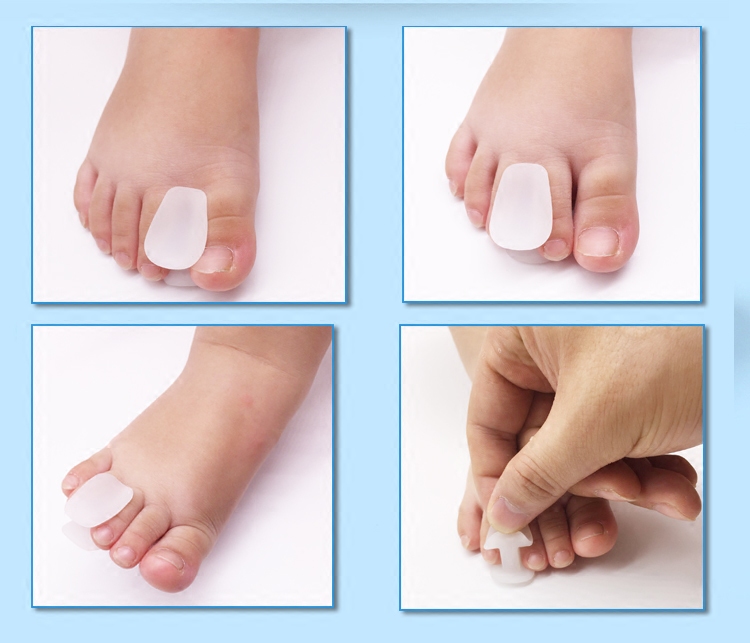 脚趾矫正儿童宝宝分离器重叠内扣外翻腿部防护用品