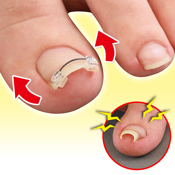 指甲日本原装预防内嵌疼痛记忆金线矫姿用品矫姿用品