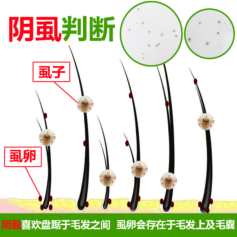 虱卵阴虱去除男女喷剂虱子百部私处用灭套装杀虫剂卫生农药