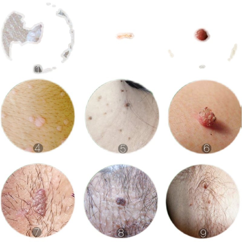 丝状治肉老鼠肉粒腋下脖子药膏瘊子特效猴子牙膏